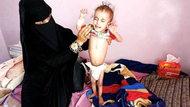 تفشي الأوبئة يتفاقم في مناطق سيطرة الحوثيين